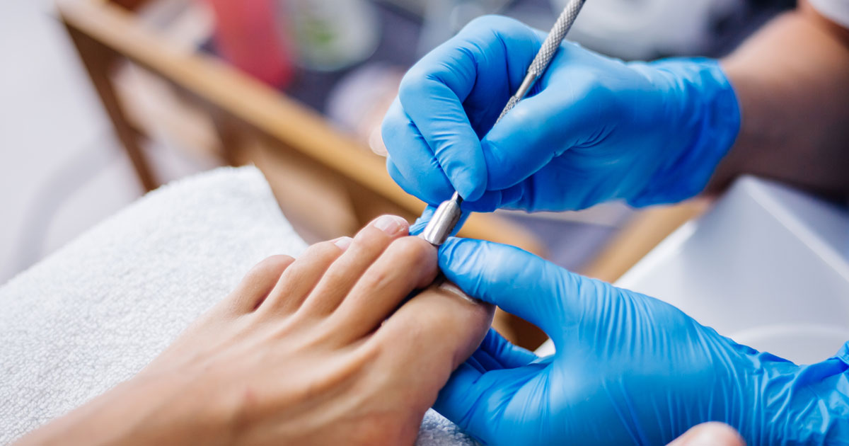 onychomycosis icd 10